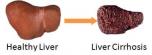 Healthy Liver Compared to Liver with Cirrhosis