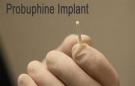FDA Considering Pricey Implant As Treatment For Opioid Addiction